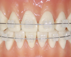 �ڗ����Ȃ������������u